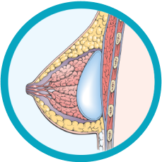 Breast after subglandular augmentation